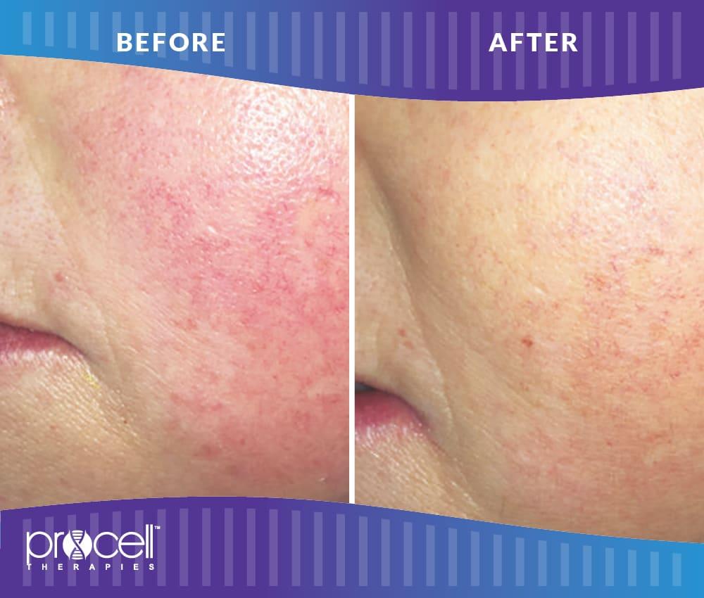 Lysa Marie INK Certified Procell Microchanneling Professional