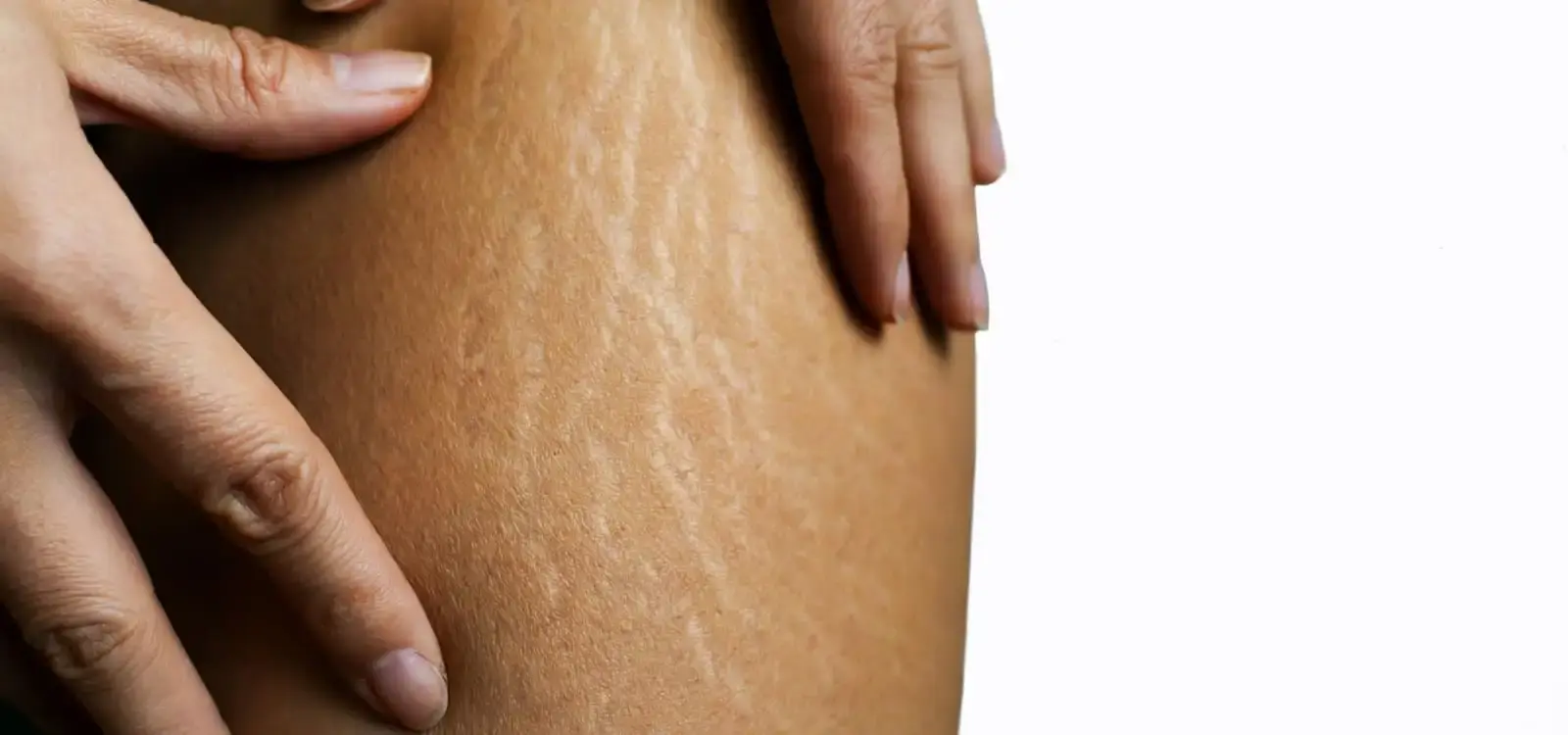 Improve the Look of Stretch Marks