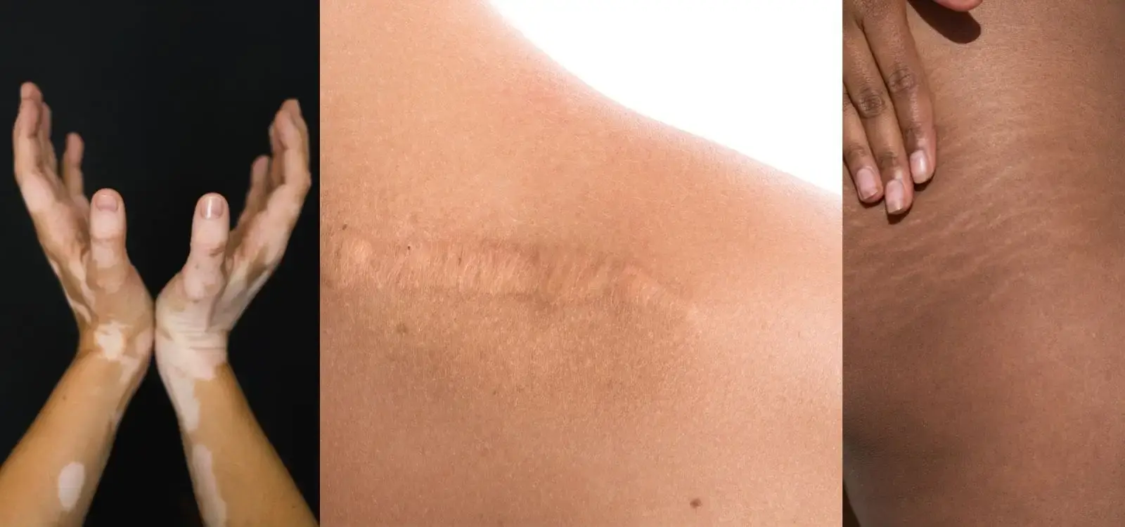 Conceal Your Skin Imperfections