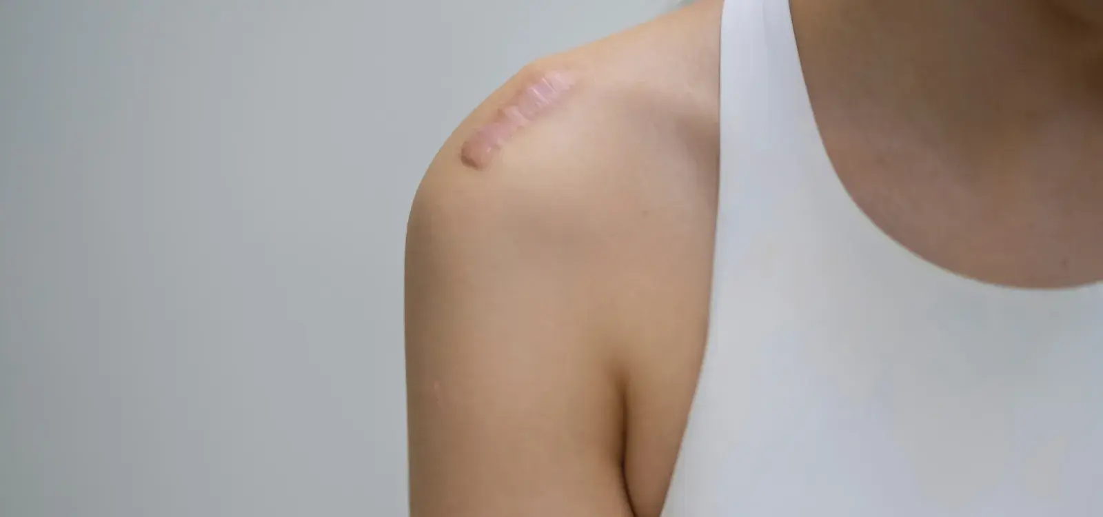 Accident Scar Camouflage