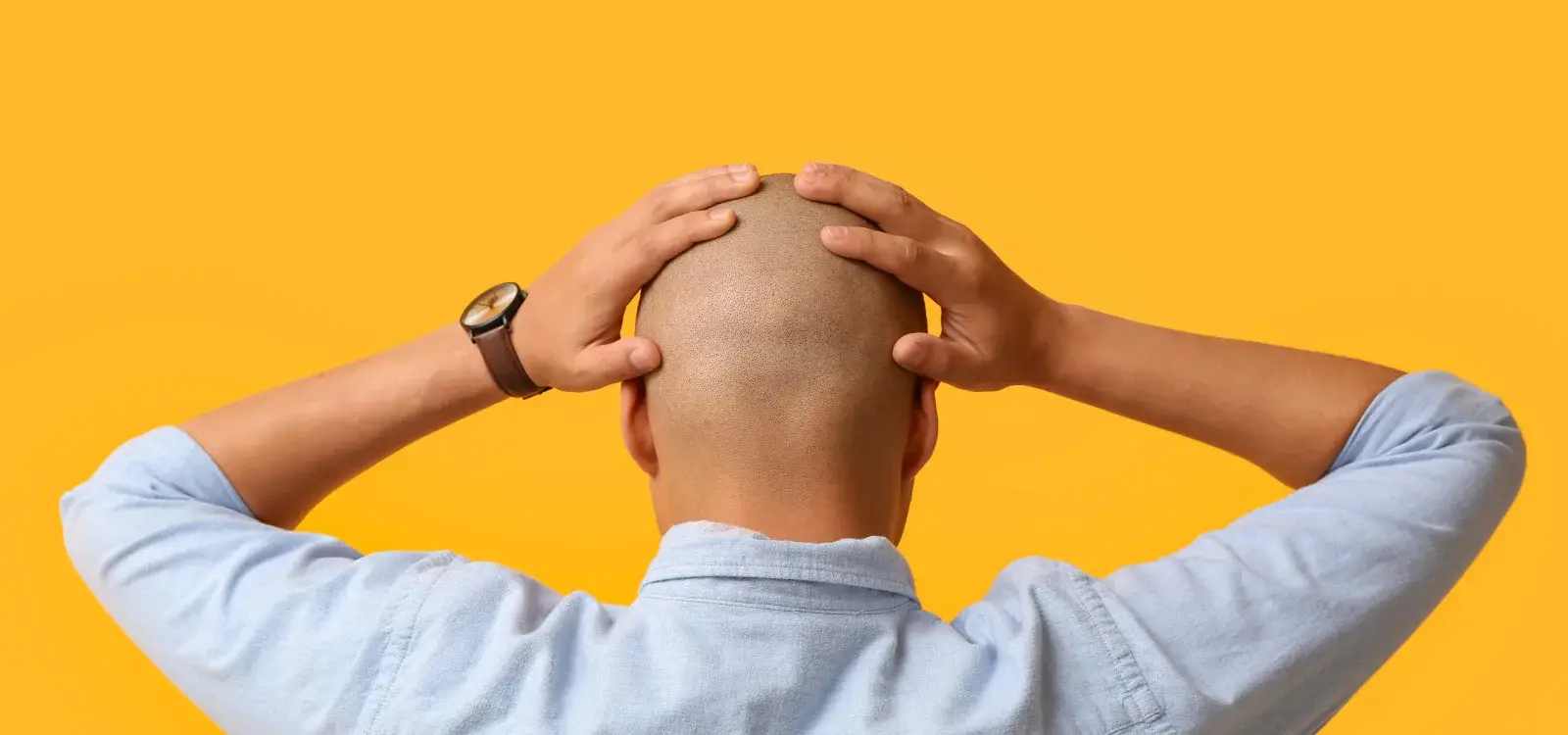 Hair Transplant Scar Camouflage