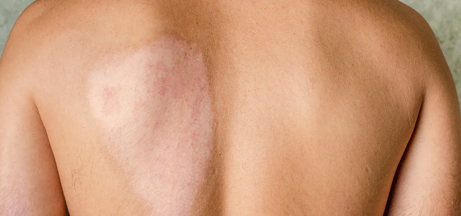 Skin Graft Scar Camouflage