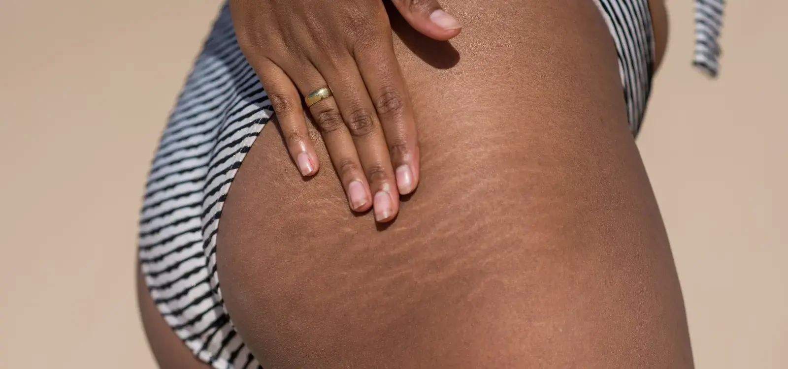 Stretch Mark Camouflage