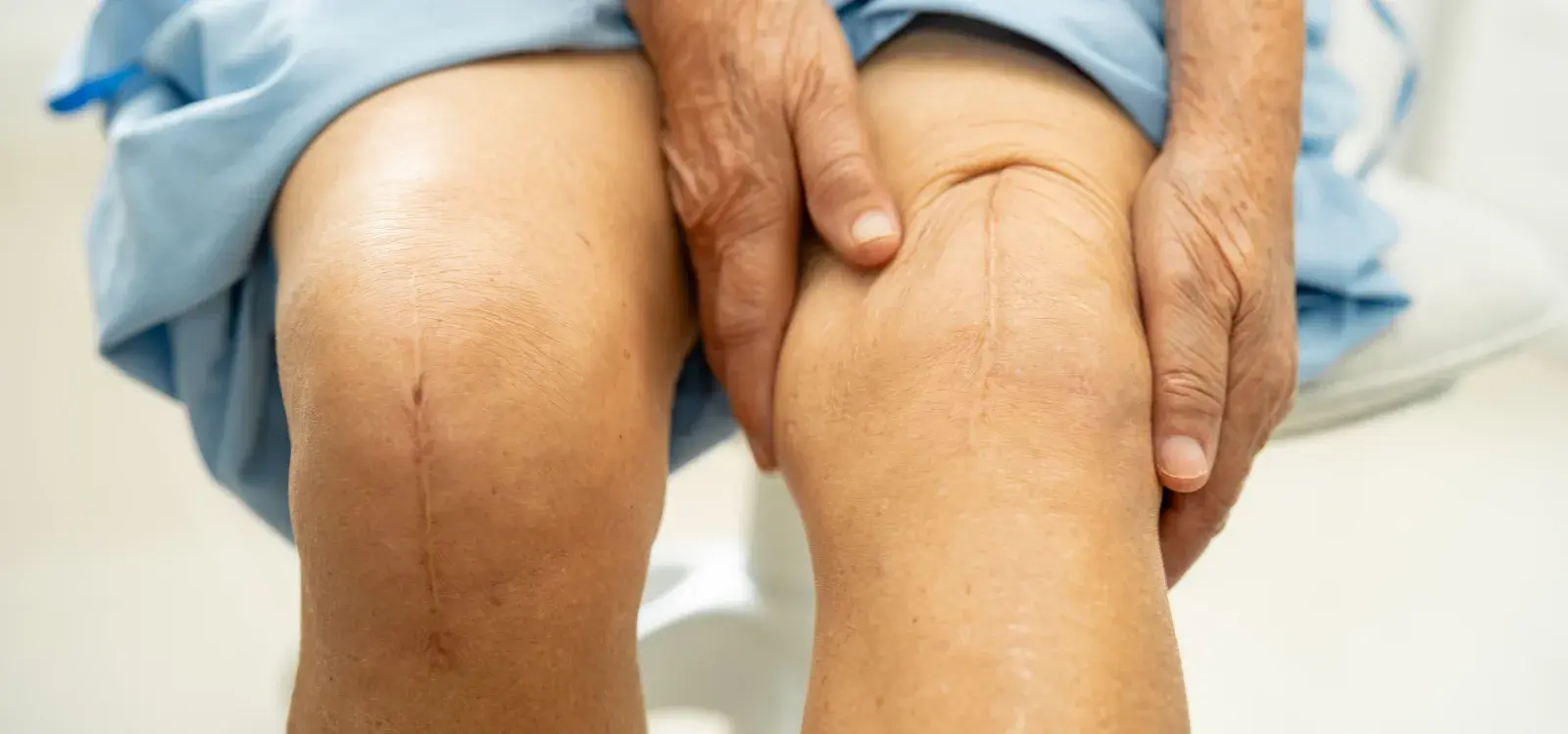 Surgical Scar Camouflage