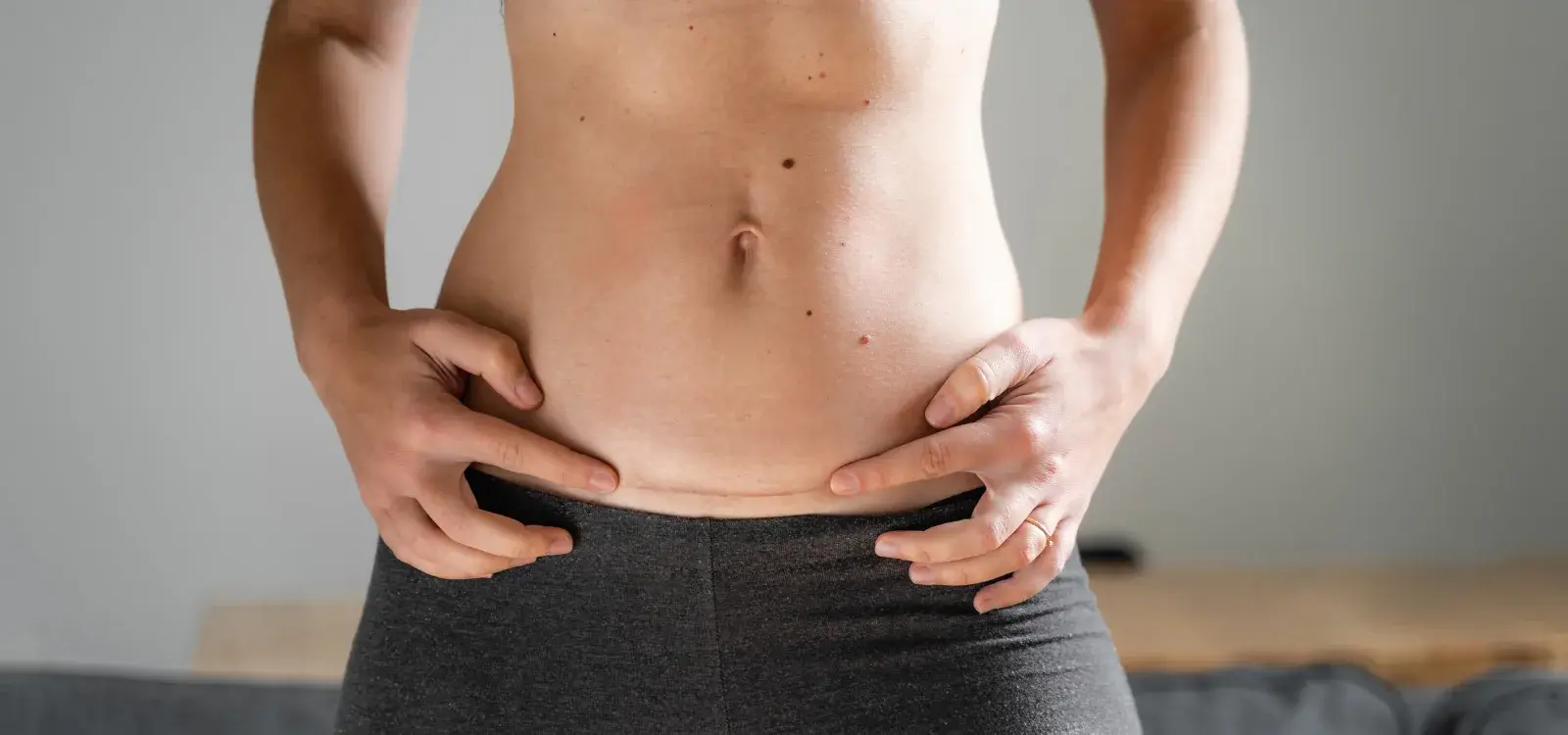 Tummy Tuck Scar Camouflage