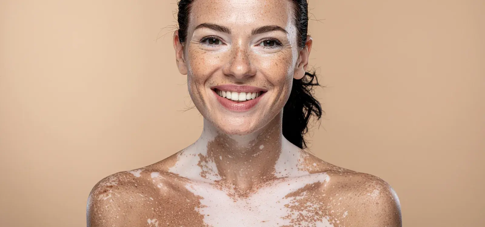 Vitiligo Camouflage