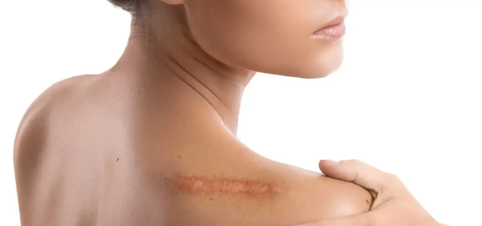 Improve the Look of Surgery & Injury Scars
